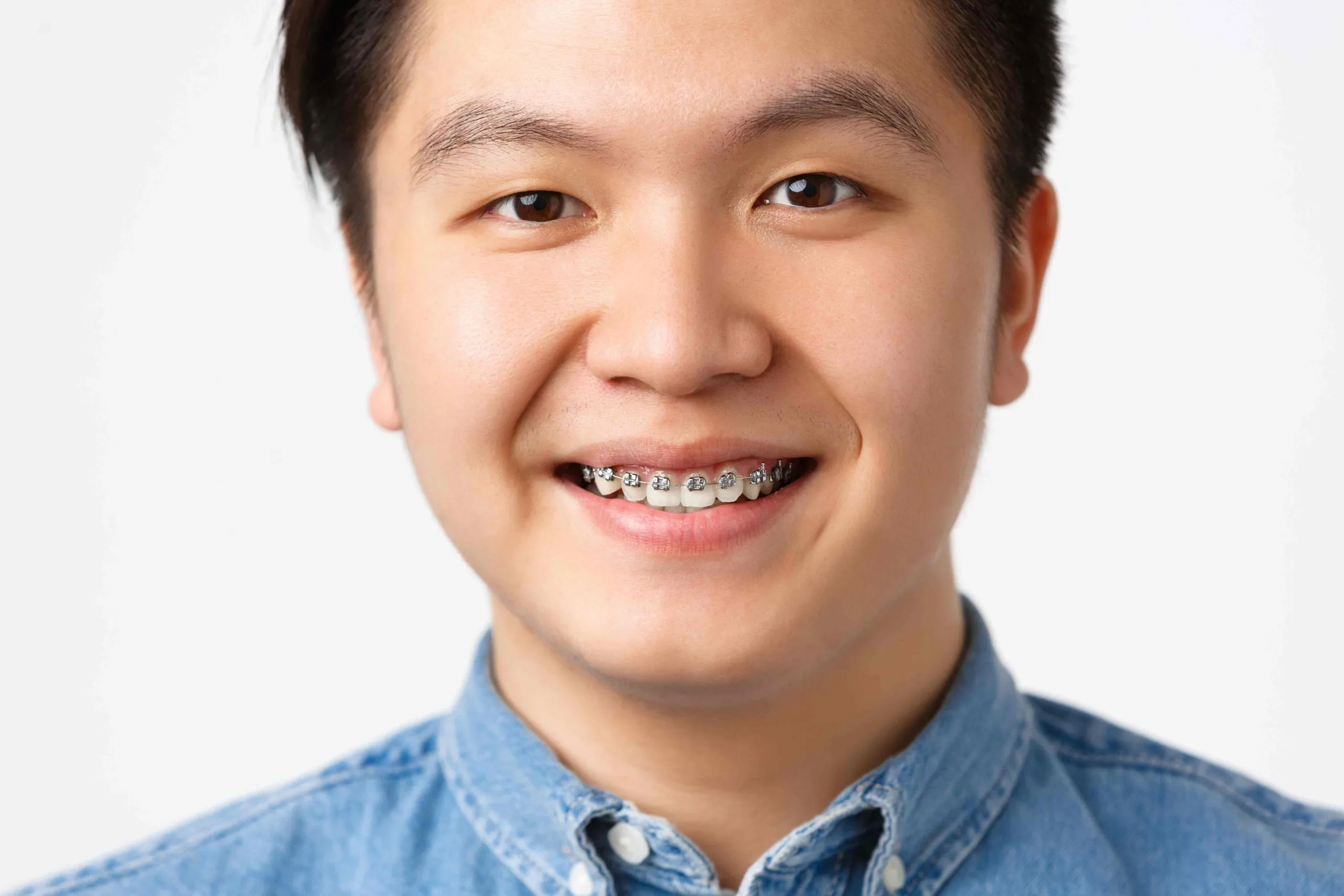 What Exactly Are Fixed Braces?