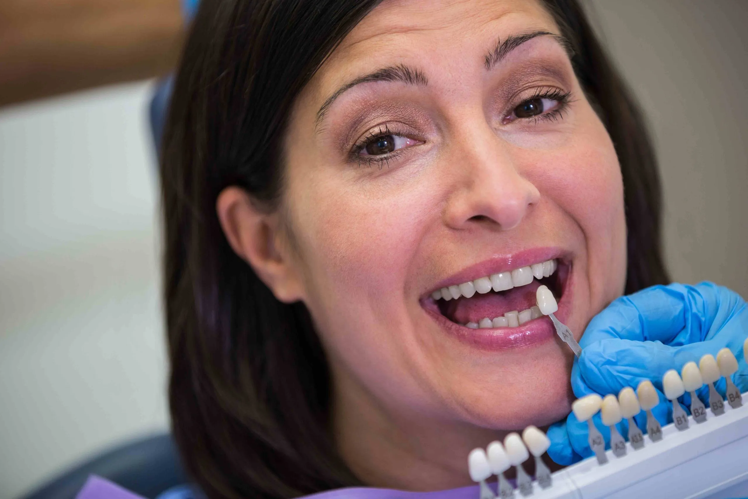 Ceramic Veneers