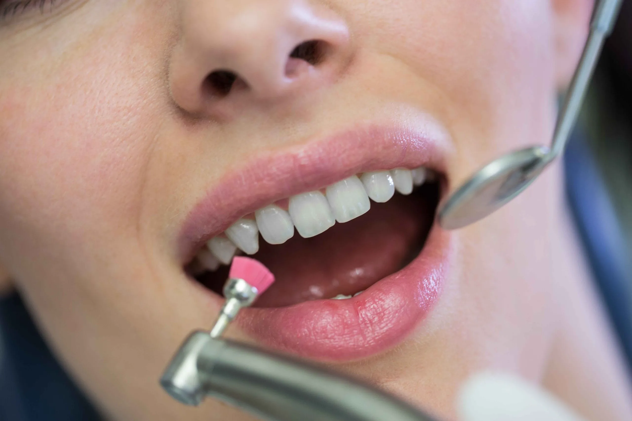 Composite Veneers